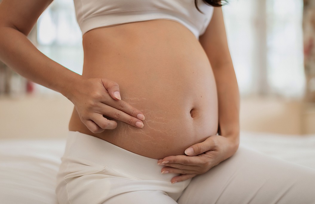 Trofolastín Anti-Estrías: Guía de uso para prevenir las estrías durante el embarazo 