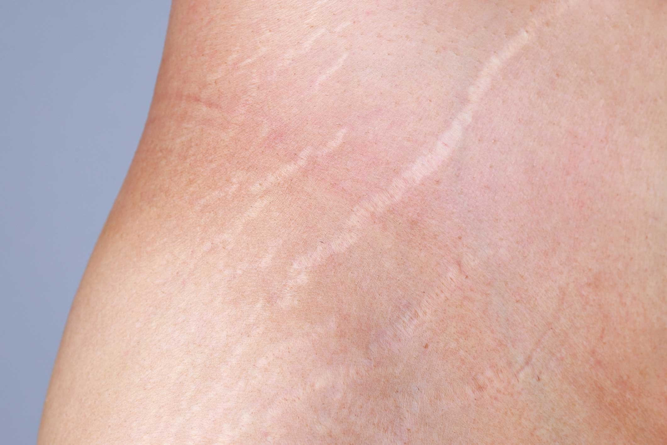 What diseases cause stretch marks?